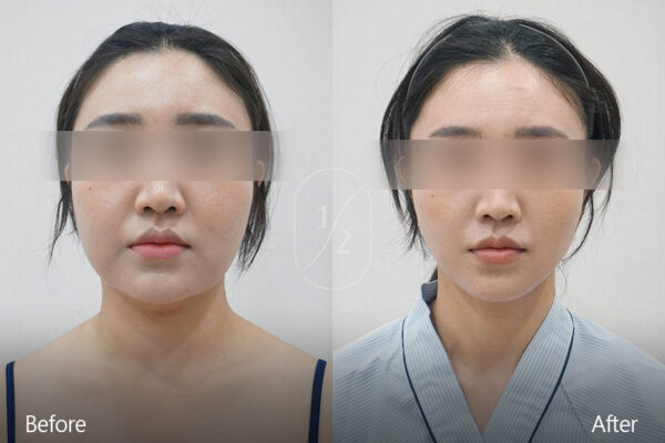 half-face-laser_before_and_after01 half-face-laser_before_and_after01