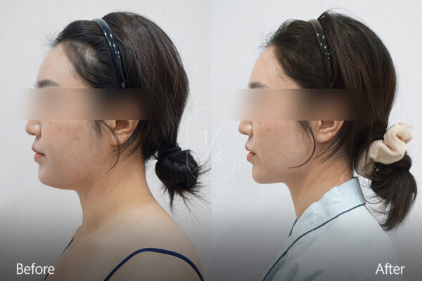 half-face-laser_before_and_after02 half-face-laser_before_and_after02