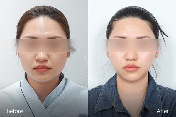 half-face-laser_before_and_after03 half-face-laser_before_and_after03
