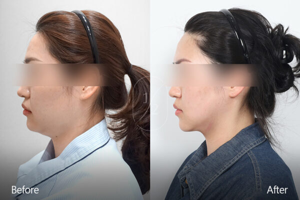 half-face-laser_before_and_after04 half-face-laser_before_and_after04