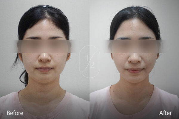 half-face-laser_before_and_after05 half-face-laser_before_and_after05