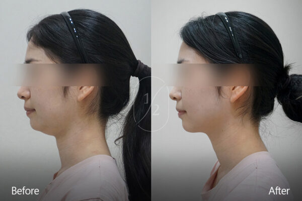 half-face-laser_before_and_after06 half-face-laser_before_and_after06